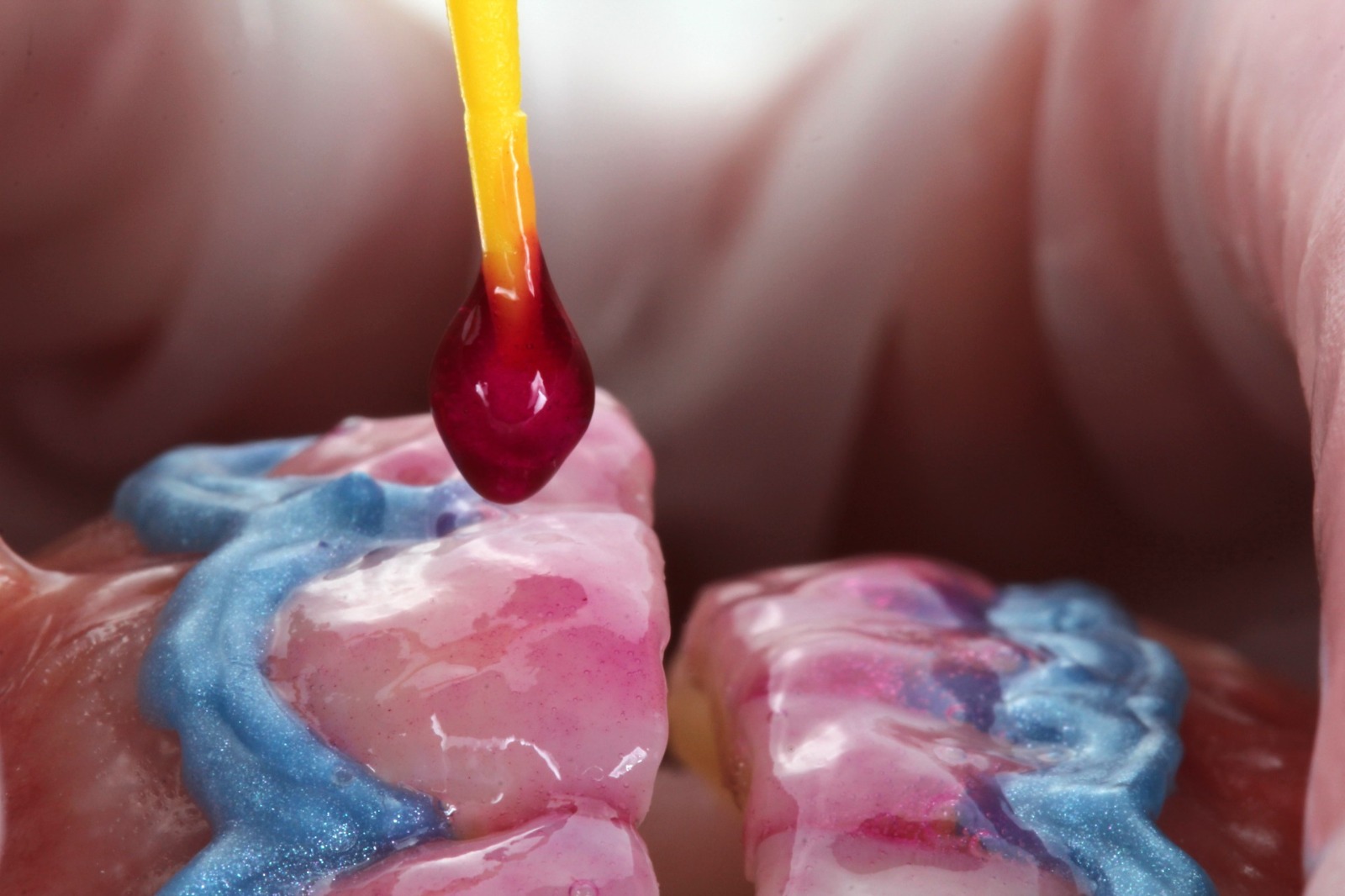 Procedimento de dentística para restauração estética do sorriso
