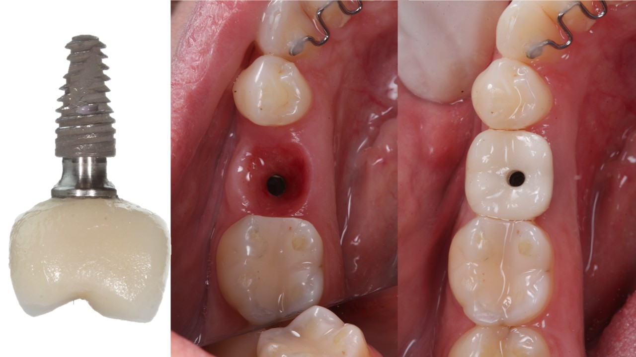 Procedimento de implante dentário com planejamento especializado