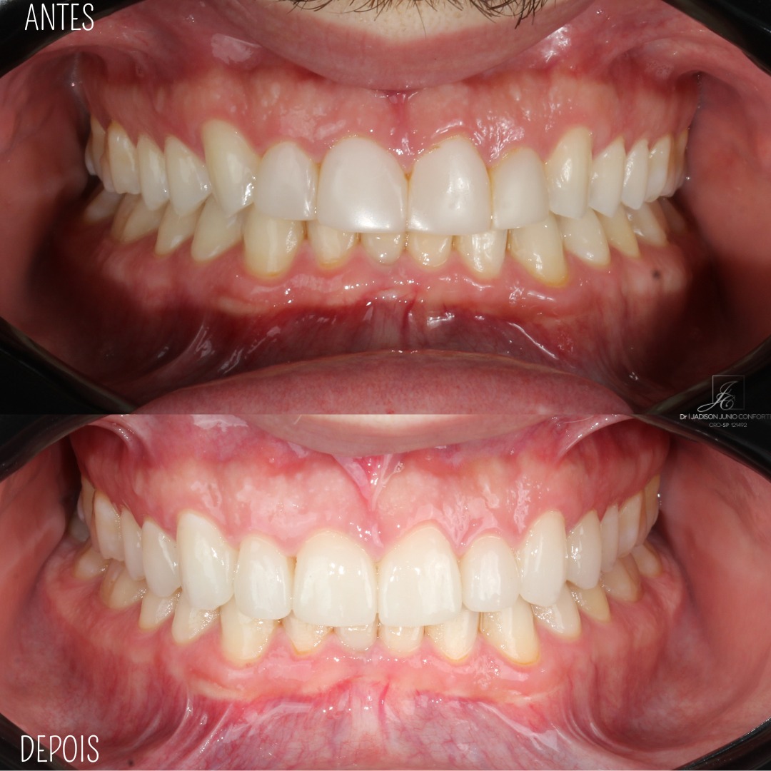 Prótese dentária para reabilitação funcional e estética